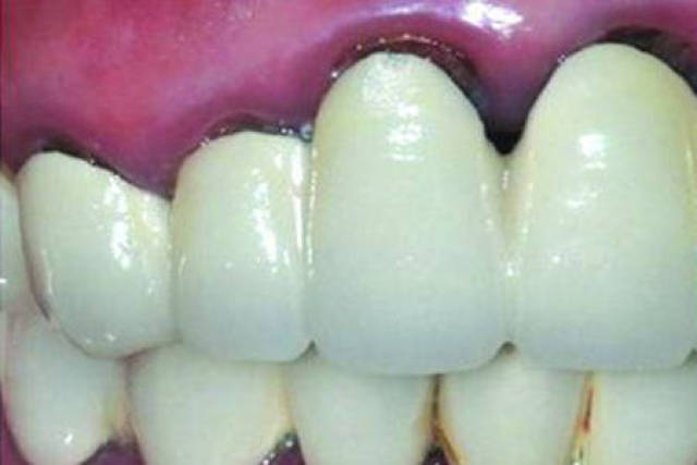 牙齿有黑线要做什么修复