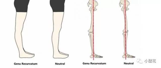 x 型腿怎么治疗 3cf9c706e60c41cd995ad0d785530ecb.jpeg