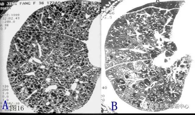 【影像基础】再看肺气肿,收获不一样
