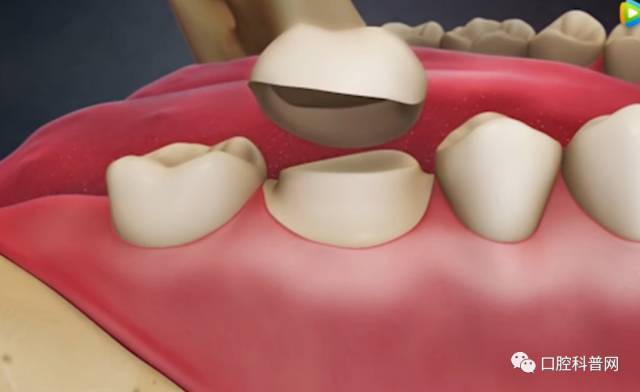 牙齿龋坏到什么程度才需要做根管治疗!