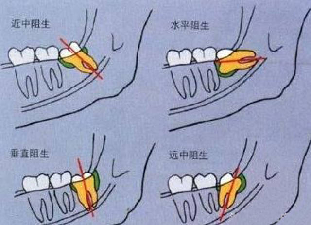 智齿拔了,邻牙会松动吗?