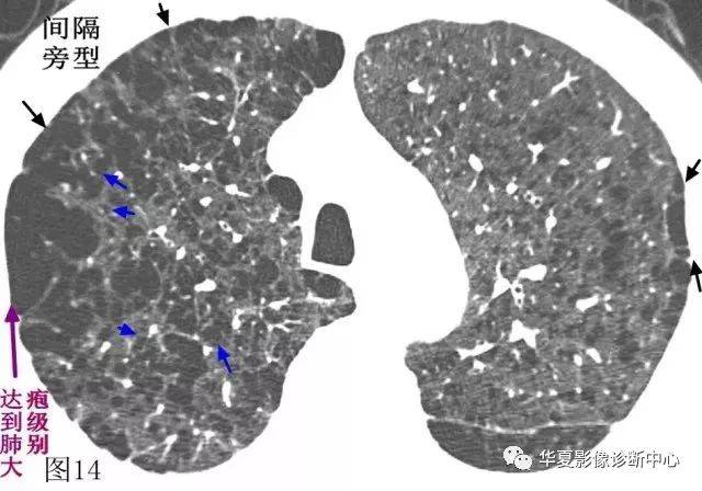 【影像基础】再看肺气肿,收获不一样