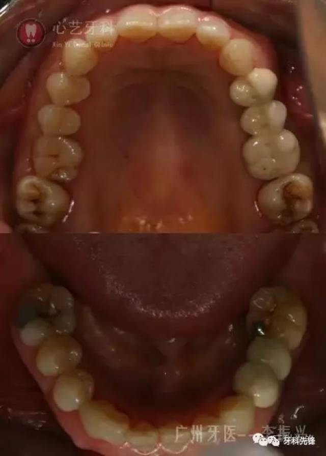 经详细口腔检查发现:"由于牙冠短小,牙齿伸长,第二磨牙的修复空间很