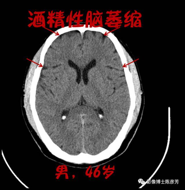 喝酒喝出脑萎缩,不是危言耸听!