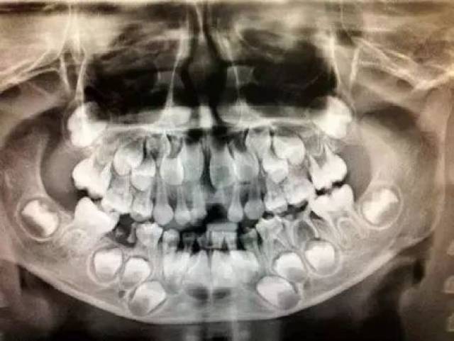 如上图,透过x光来看到换牙时期颌骨内的情况是这样的.
