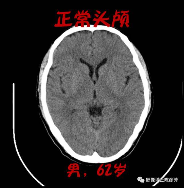 喝酒喝出脑萎缩,不是危言耸听!