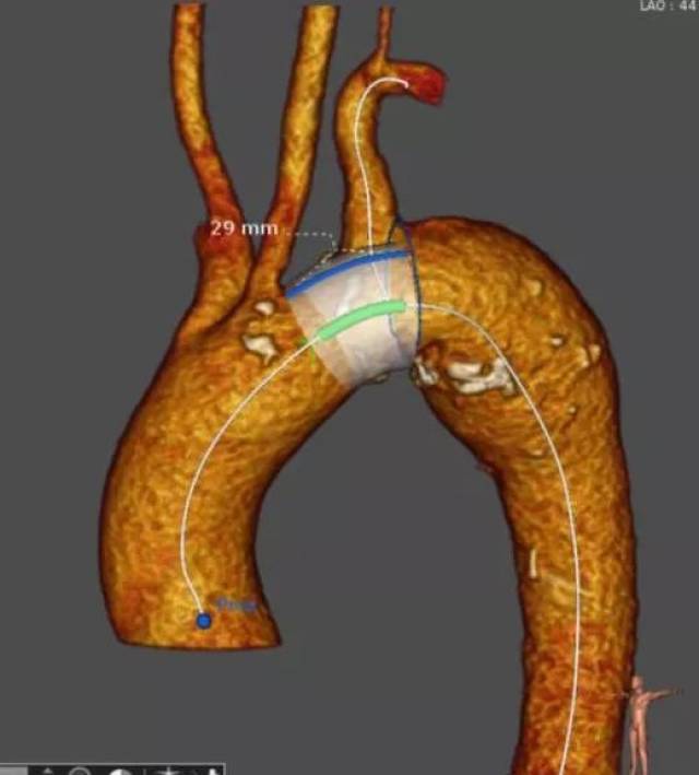 【病例分享】castor分支型主动脉覆膜支架系统治疗主动脉弓部动脉瘤