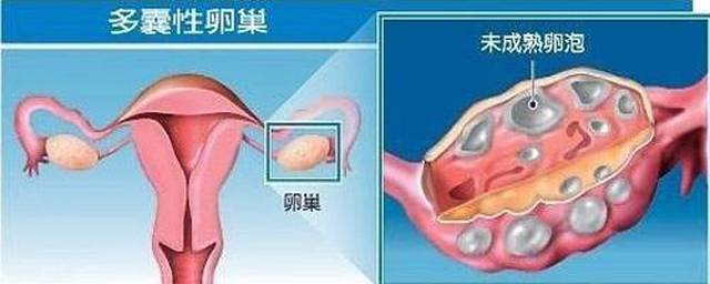 蔓立安:青春期遇上多囊卵巢是怎样一种情况?