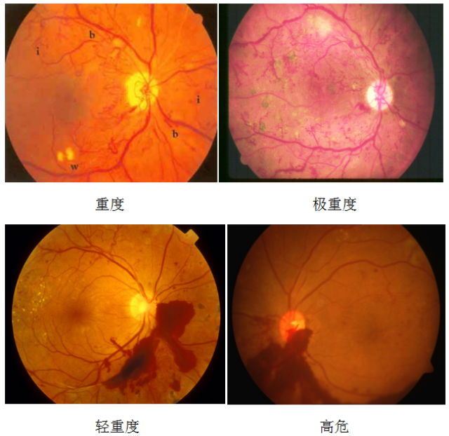 白内障,视网膜视神经疾病