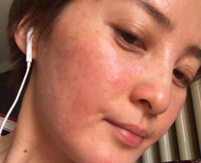 【兰蓉说】激素脸和痘痘脸如何区别?