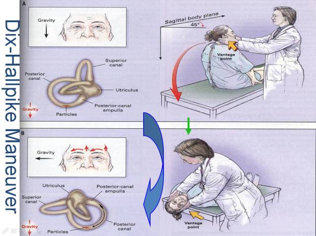 于刚教授:bppv变位试验与手法复位(内附精彩教学视频)