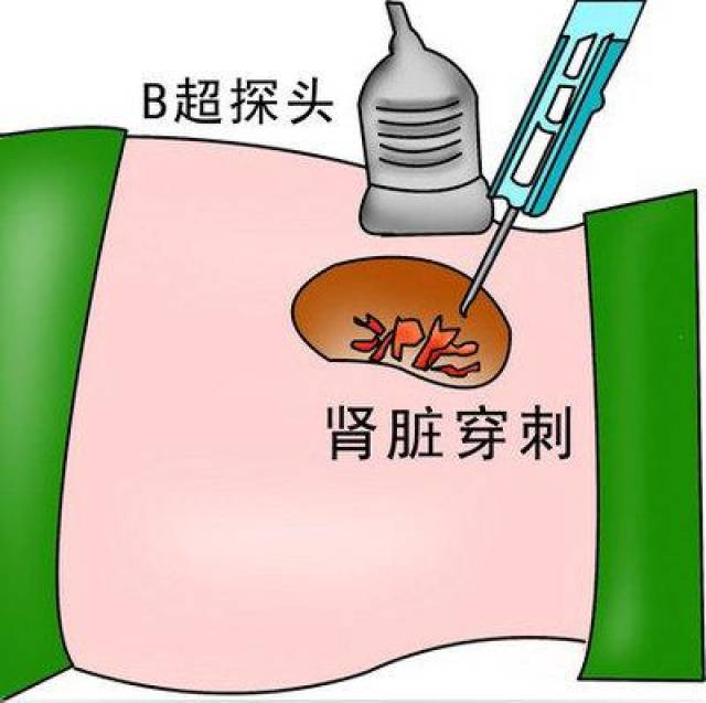 肾病综合征患者都要穿刺吗?哪些肾综患者可以不做肾穿刺呢?