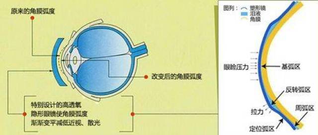 角膜塑形镜安全性高