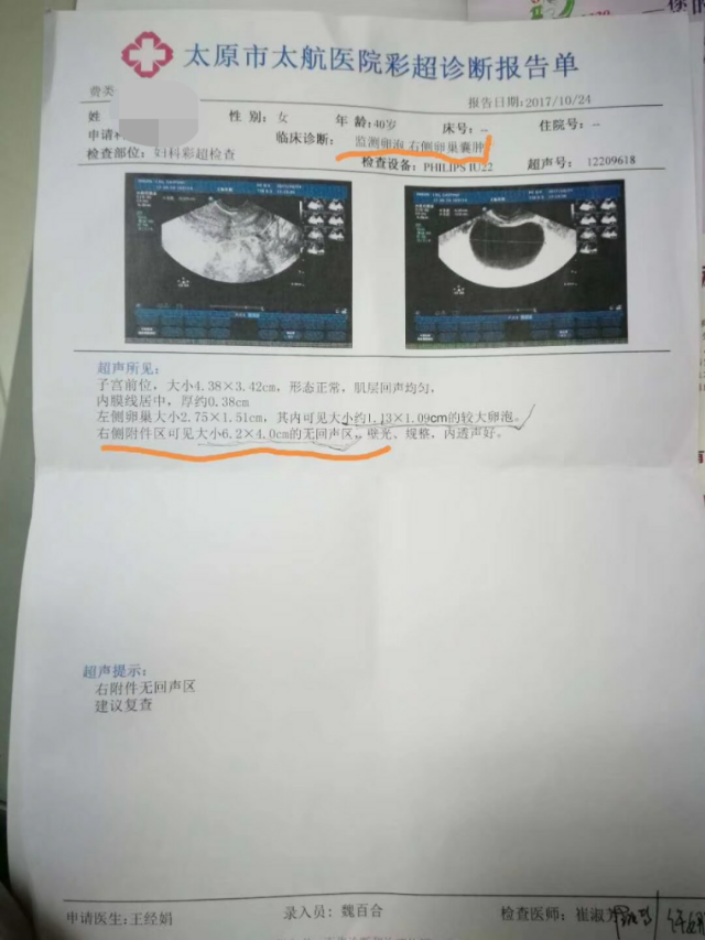 艾灸曾芳:卵巢囊肿,艾灸一个月,结果让我吃惊!