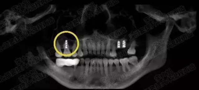 【精品课程】解决90%以上上颌窦提升病例,安全内提10mm ‖ 深圳站第