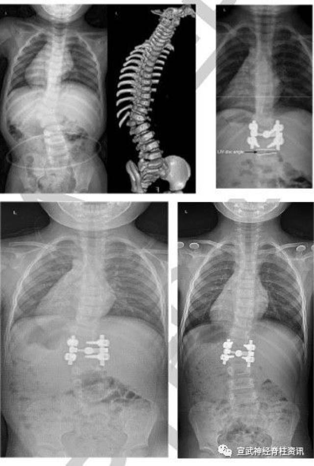 [脊柱]儿童脊柱侧弯单纯后路胸腰段半椎体切除及短节段融合术后冠状面