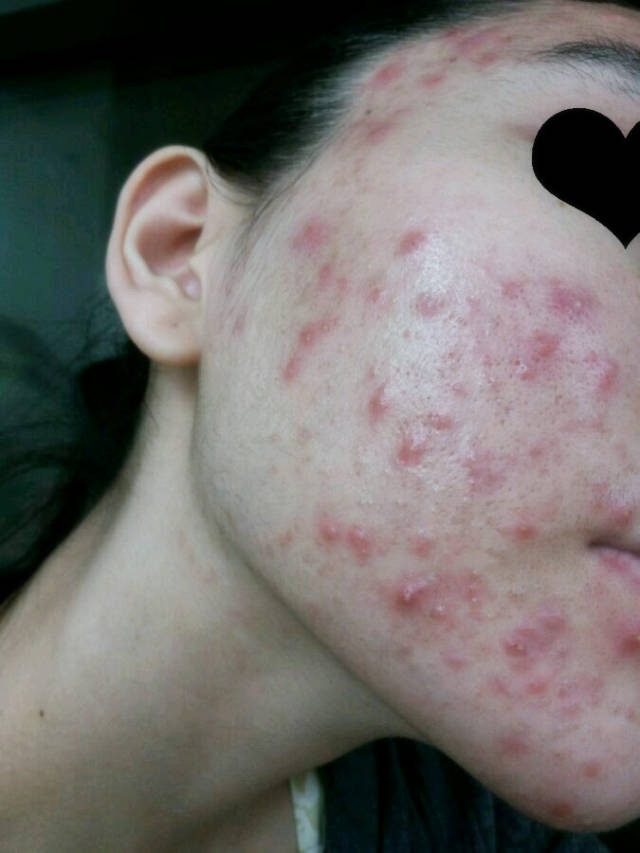 结节囊肿型痘痘图片_囊肿型痘痘怎么治疗_结节囊肿型痤疮图片-圈子花园图片