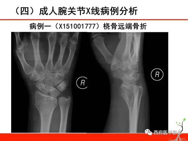 早读| 成人腕关节外伤x线诊断技巧