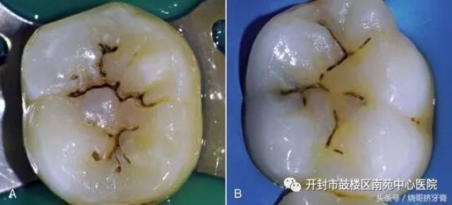 牙齿上有小黑点是怎么回事?