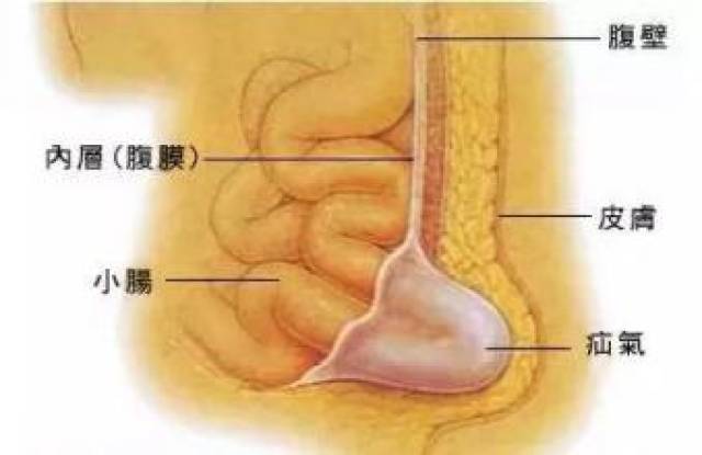 女性得了疝气应该注意什么?女性必看!