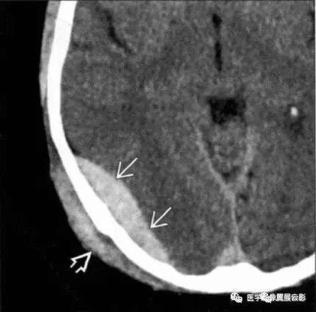 解读:创伤后急性帽状腱膜下血肿,不受颅缝限制,伴硬膜外血肿    脂肪