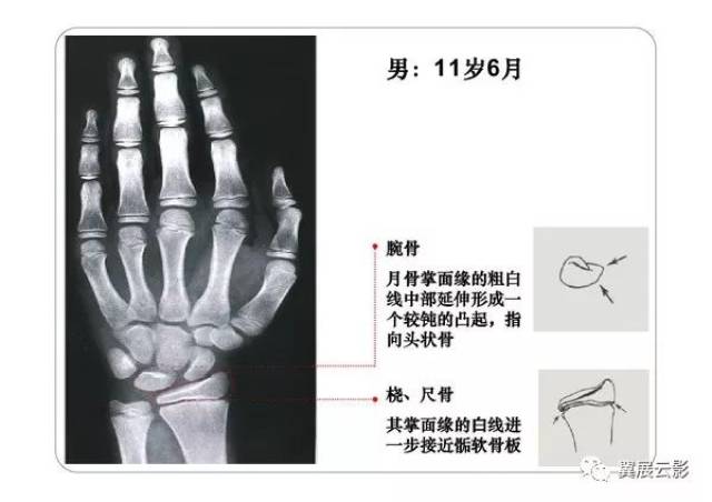 看完这篇文章,再也不怕写骨龄报告了_手机搜狐网