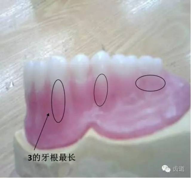 6,牙根长度要适中(图黒圈处).