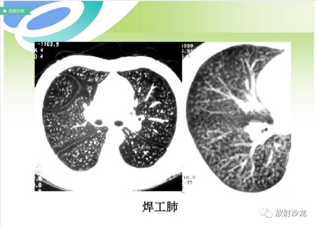 肺部病变的ct影像基本征象