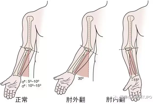 矫形:孩子胳膊肘向里拐---肘内翻