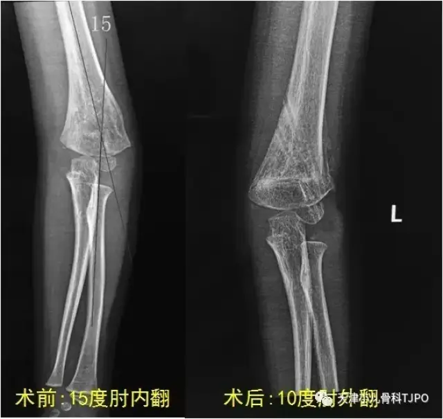 手术其实很简单,通过去掉外侧多余的三角形骨块,对合上以后,肘关节就