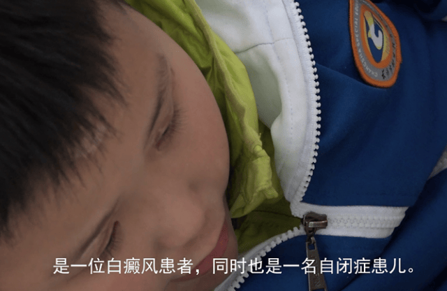 9岁自闭症儿童突患白癜风，长沙华山医院爱心援助