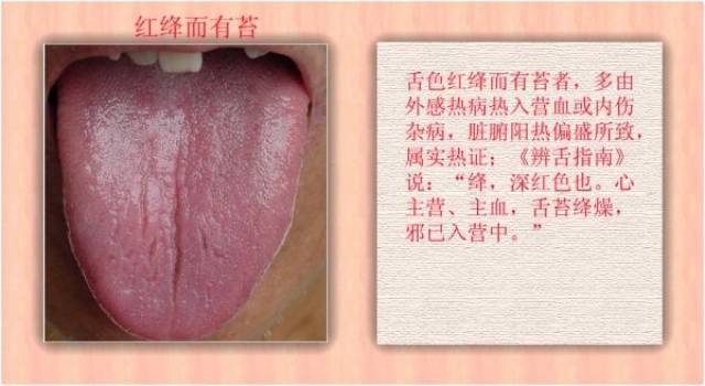 看舌苔怎样辨别身体健康?