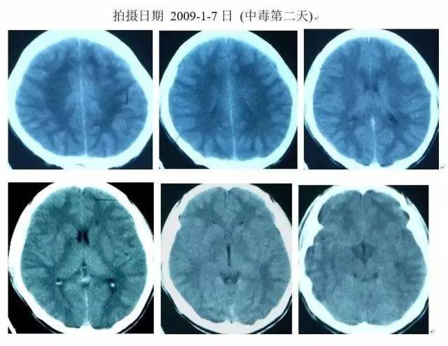 中毒第2天头部ct