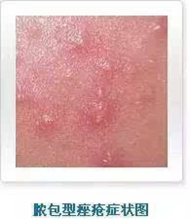 脓包型痘痘 脓包型痤疮症状:脓包型痤疮主要是由丘疹型痤疮演变而来