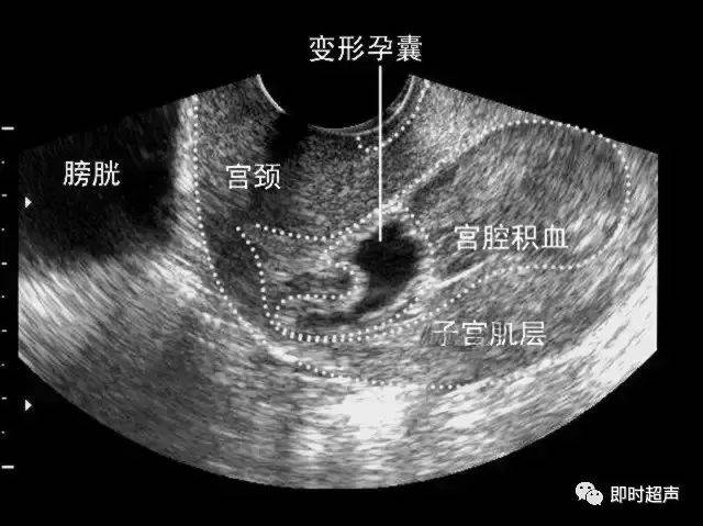 流产的超声表现