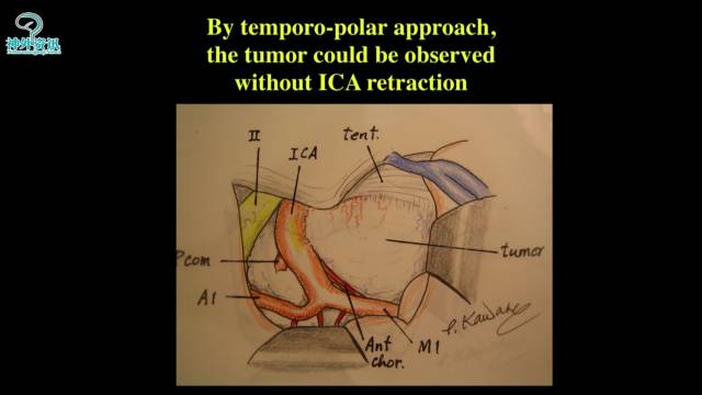 【正海-妙术视界】| kawase教授:后床突脑膜瘤的手术技巧,三角与岩前