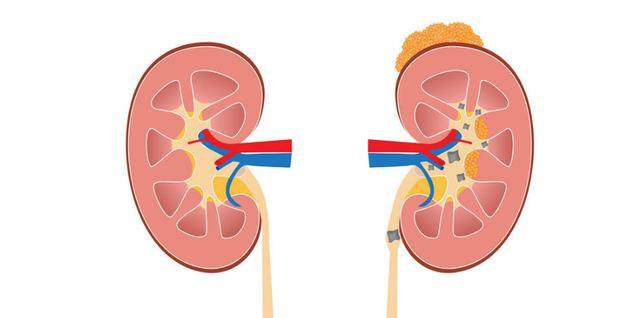 这4个坏习惯不改掉,肾结石迟早找上门来