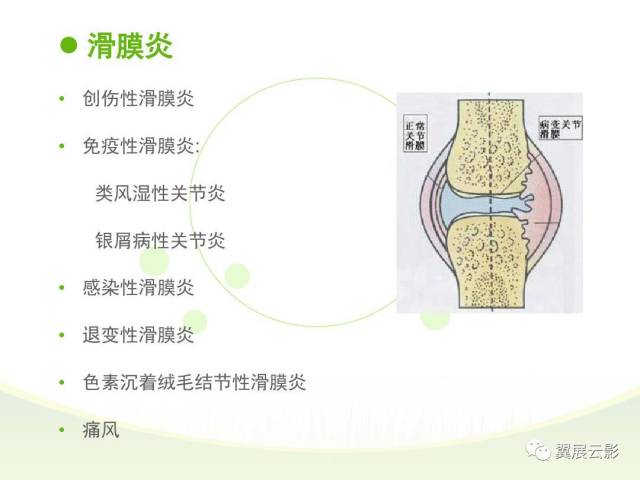 膝关节滑膜病变mri表现