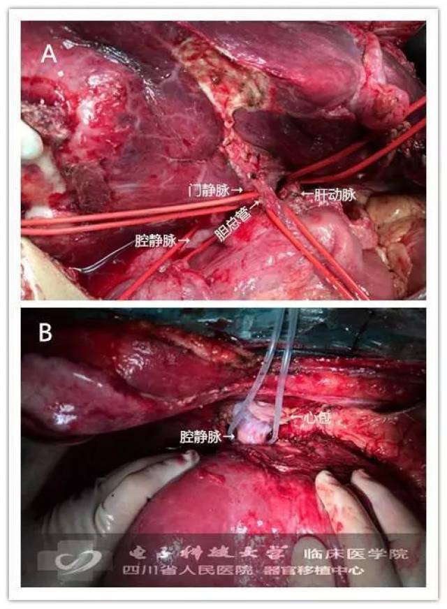 手术解析:复杂肝占位离体肝切除 自体肝移植术