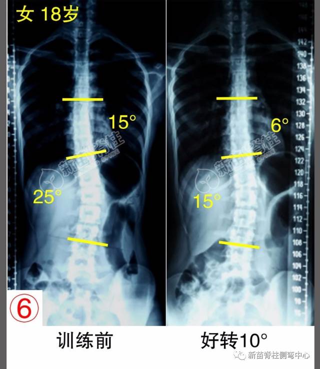 成年人轻度脊柱侧弯没关系?事实:你还得长点心!