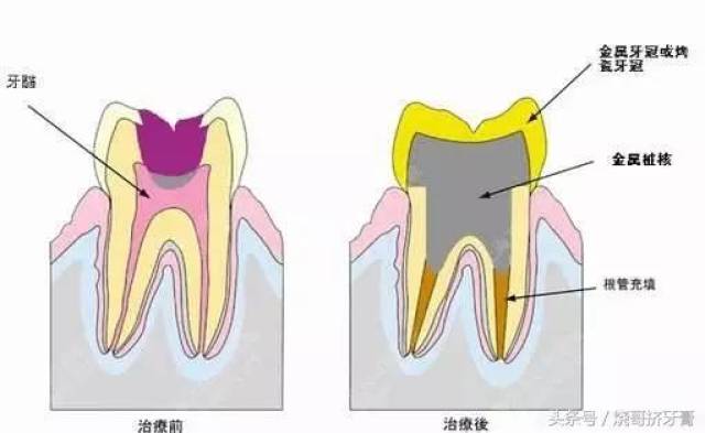 牙齿不杀牙神经可以直接拔牙?