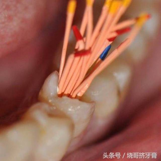 牙齿不杀牙神经可以直接拔牙?