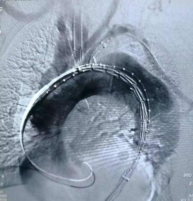 【病例分享】castor分支型主动脉覆膜支架系统治疗胸主动脉夹层