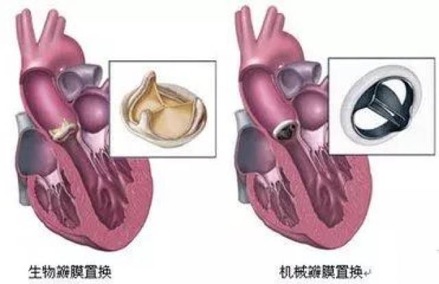 100个高龄老人14个瓣膜有问题未来这种病有可能超越冠心病