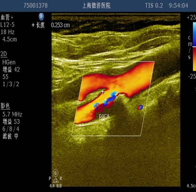 (图八:为右侧颈内动脉走形扭曲) 颈动脉超声检查有助于确定缺血性脑