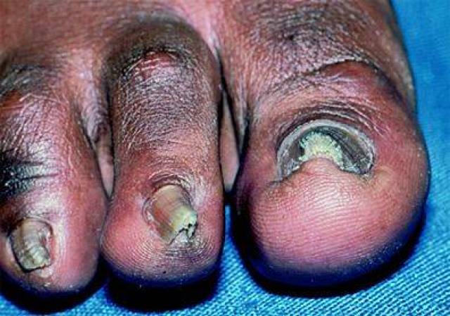 皮科新观察丨嵌甲的治疗