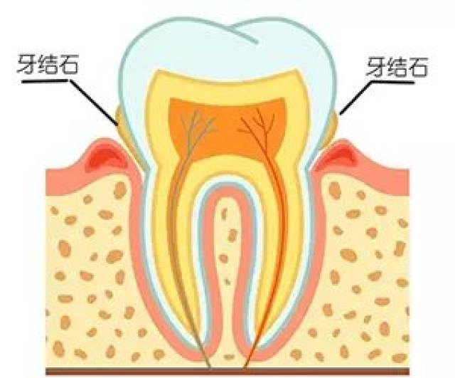 牙结石为什么那么臭