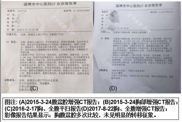 「结肠癌术后高危预防—nkt治疗案例展示」清华nkt · 乐和亲友