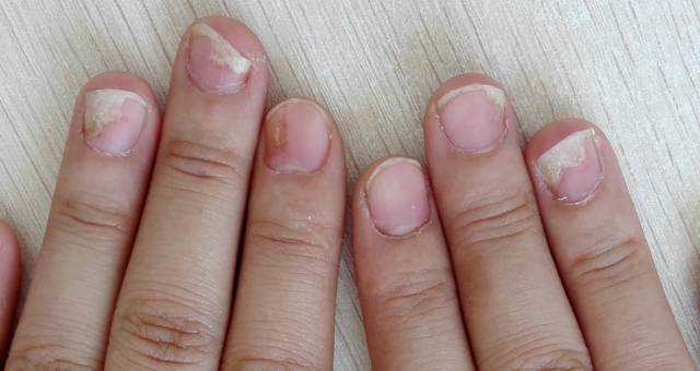 指甲损害符合银屑病表现. 3.真菌检