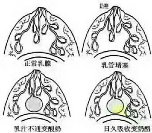 成都催乳师培训林老师:乳头小白点分为几种?